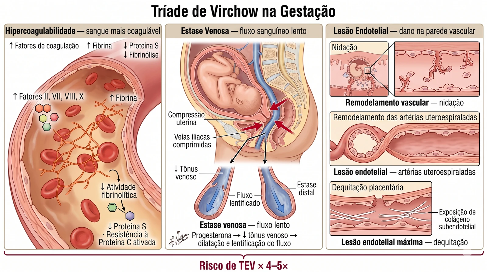 Fig. 5 — Tríade de Virchow na gestação