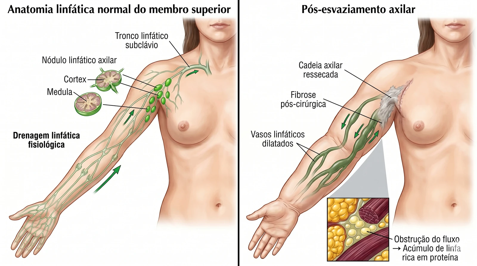 Fig. 2 — Consequências da ressecção axilar