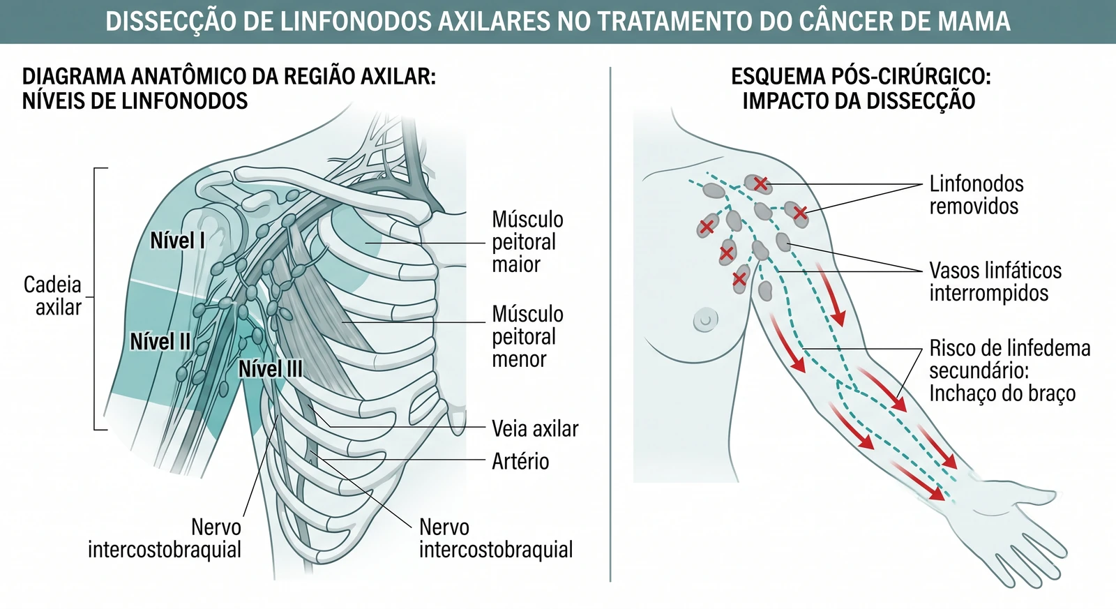 Fig. 1 — Ressecção de linfonodos axilares