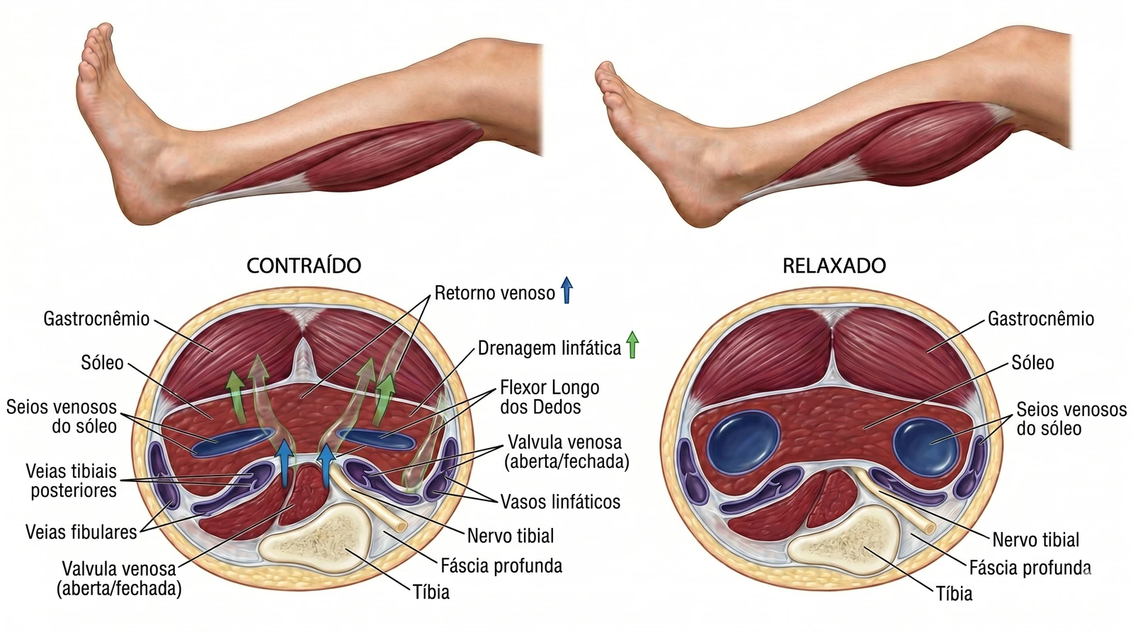 Fig. 3 — Gastrocnêmio e sóleo contraídos comprimem os vasos linfáticos e venosos profundos, impulsionando o retorno linfático e venoso contra a gravidade.