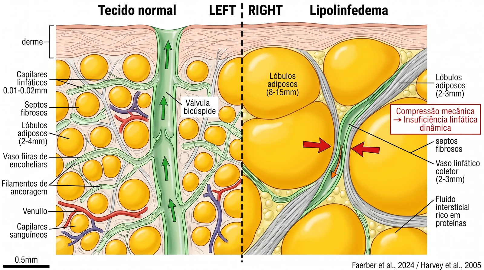 Fig. 1 — Esquema do mecanismo do lipolinfedema