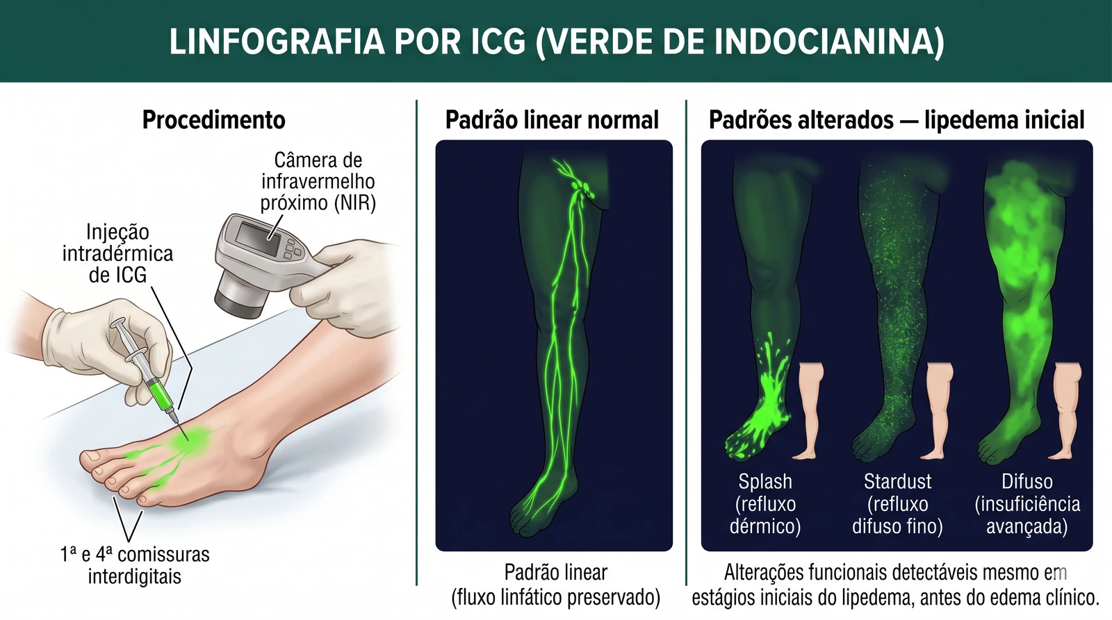 Fig. 5 — Linfografia por ICG (verde de indocianina)