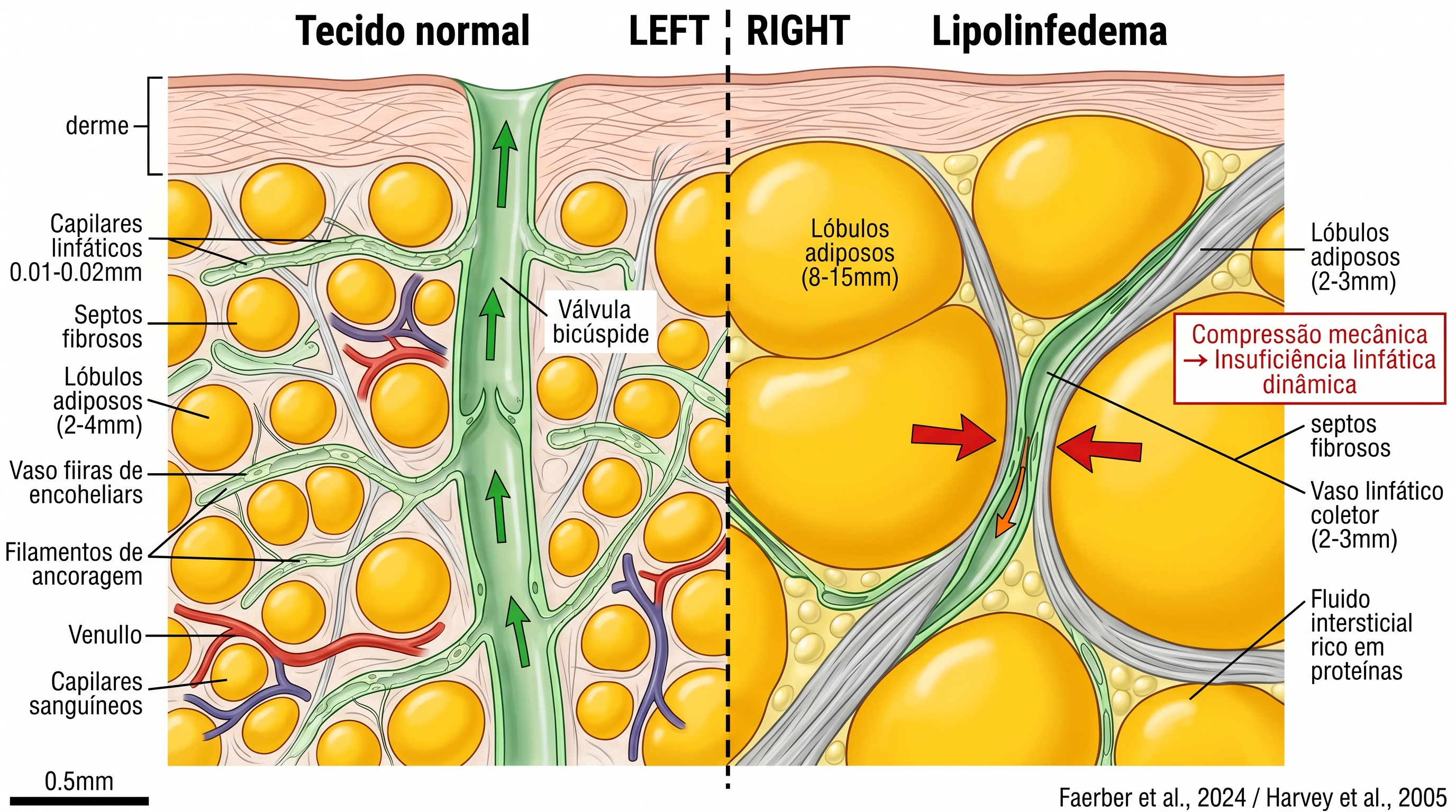 Fig. 1 — Esquema do mecanismo do lipolinfedema