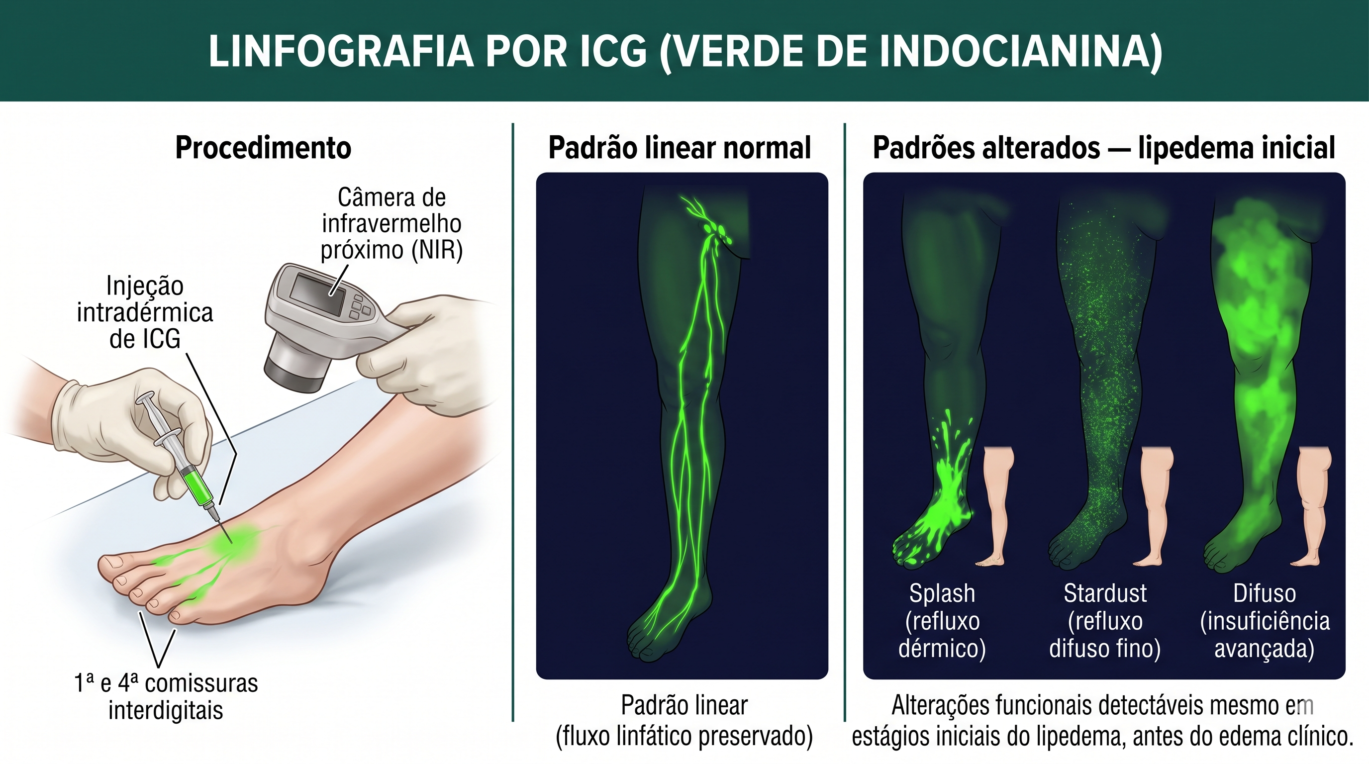 Fig. 5 — Linfografia por ICG (verde de indocianina)
