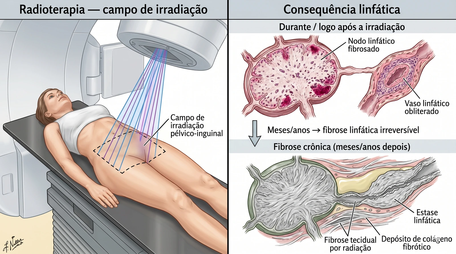 Fig. 4 — Dano linfático por radioterapia